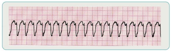 v tach pr interval